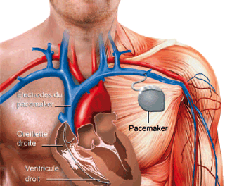 fonctionnement d'un pacemaker