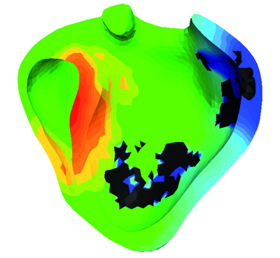 Simulation de l’activité électrique dans les 2 ventricules cardiaques 